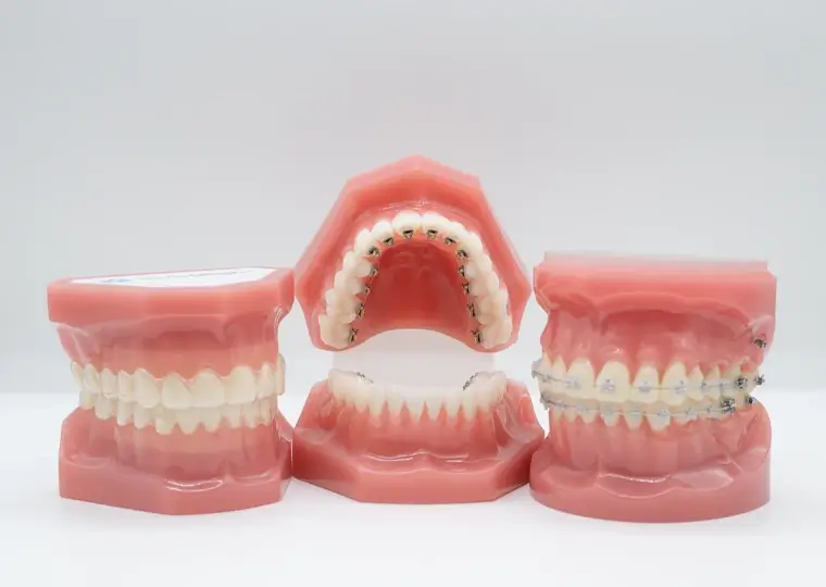 20・30代におすすめの目立ちにくい矯正