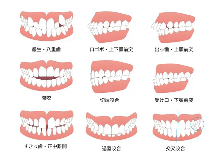 治療が必要な歯並び