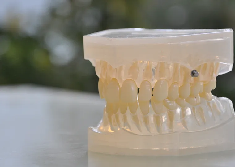 歯科矯正用アンカースクリュー