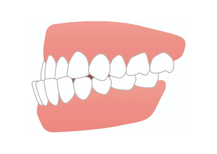 受け口は６歳を待たず早めに