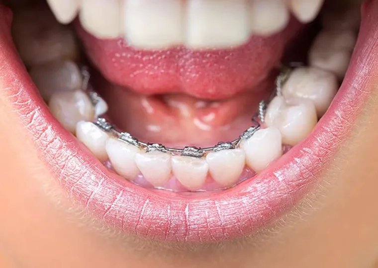 リンガルブラケット(歯の裏側のワイヤー矯正)