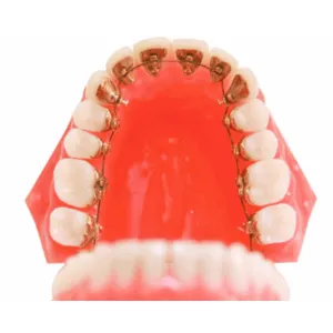 リンガルブラケット装着