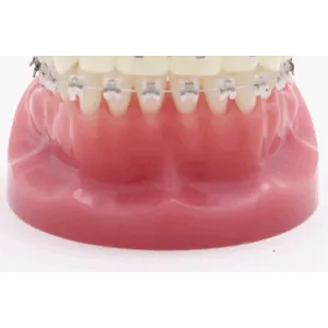 ラビアルブラケット装着