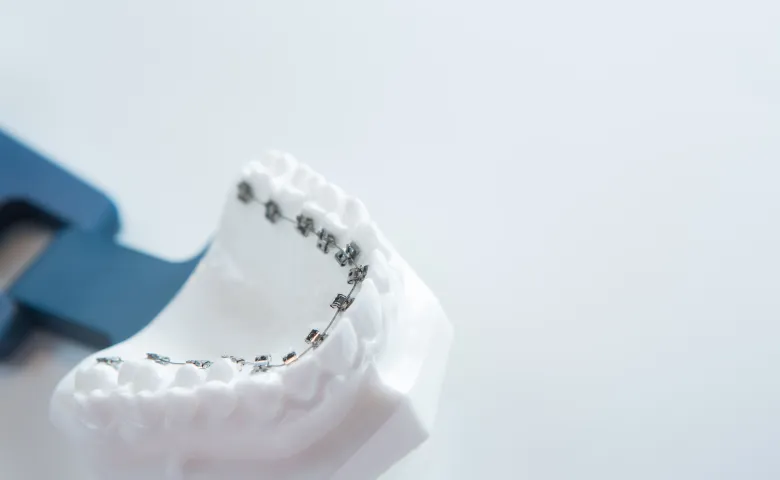 舌側矯正（裏側）