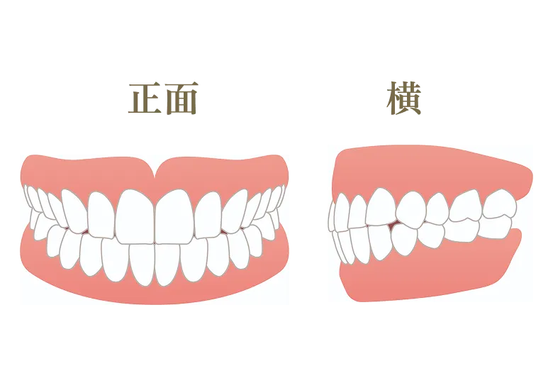 正常咬合（正しい歯並び・噛み合わせ）とは