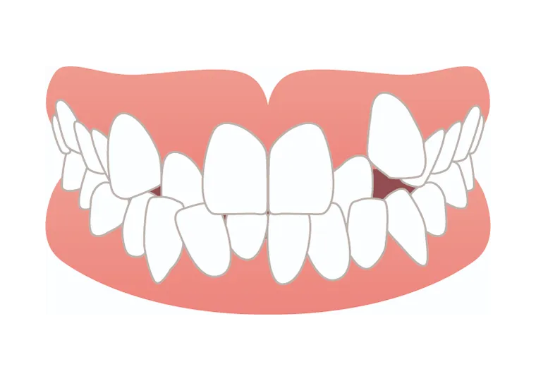 ガタガタ・八重歯・叢生