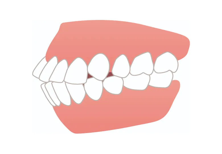 口ゴボ・上下顎前突