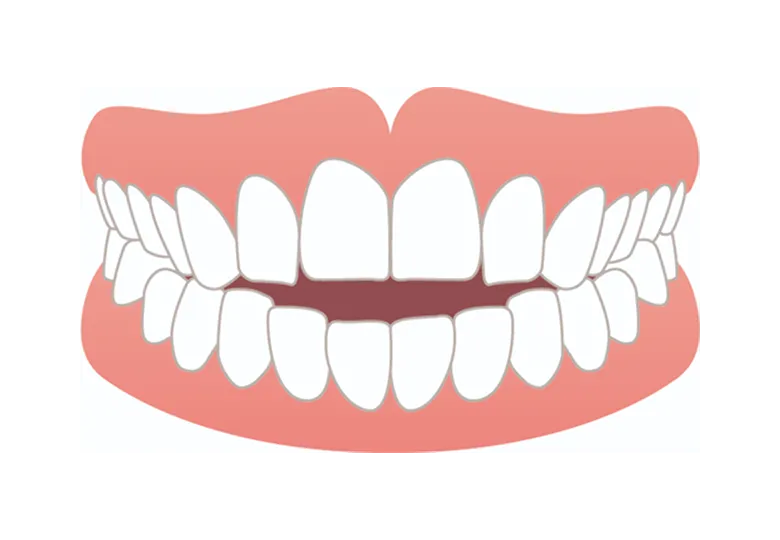 前歯で噛めない開咬