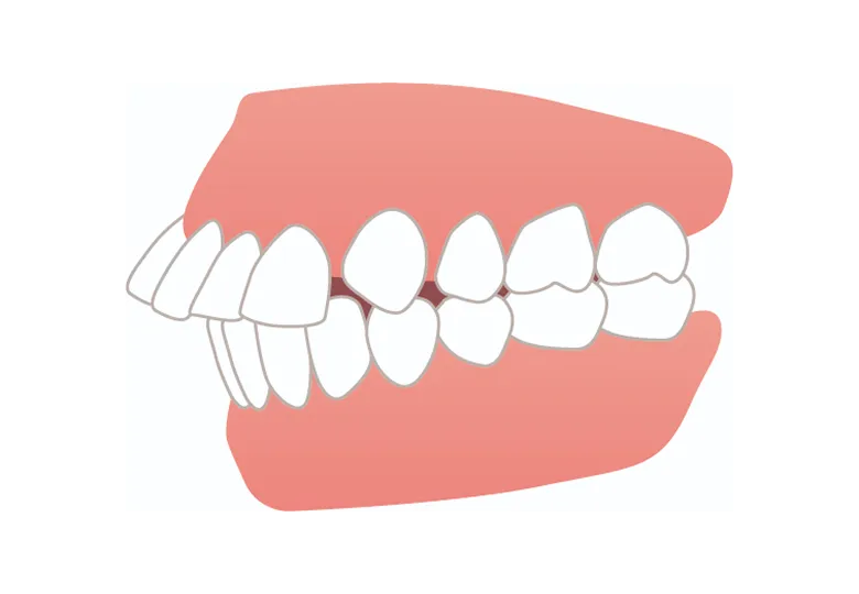 出っ歯・上顎前突