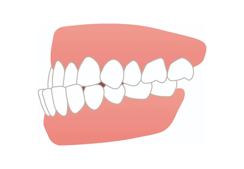 受け口・下顎前突