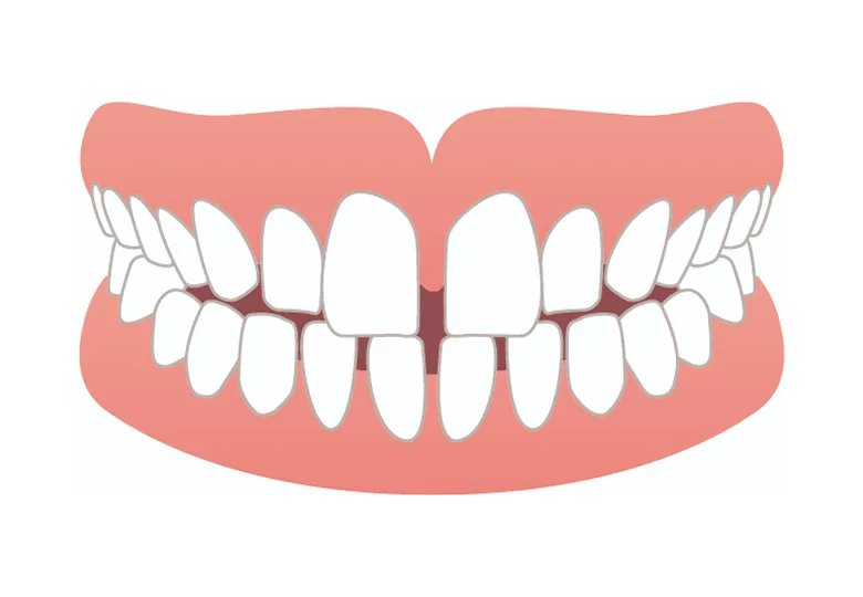 すきっ歯・正中離開