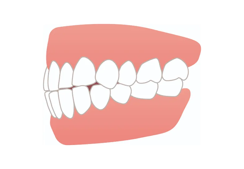 前歯でぶつかる切端咬合
