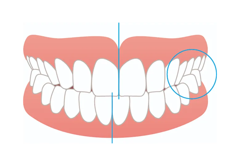前歯でぶつかる切端咬合