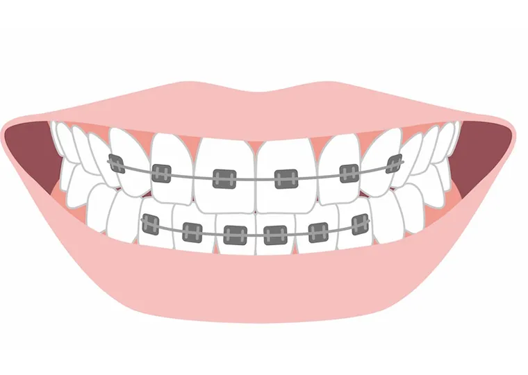 気になる部分だけ整える部分矯正とは