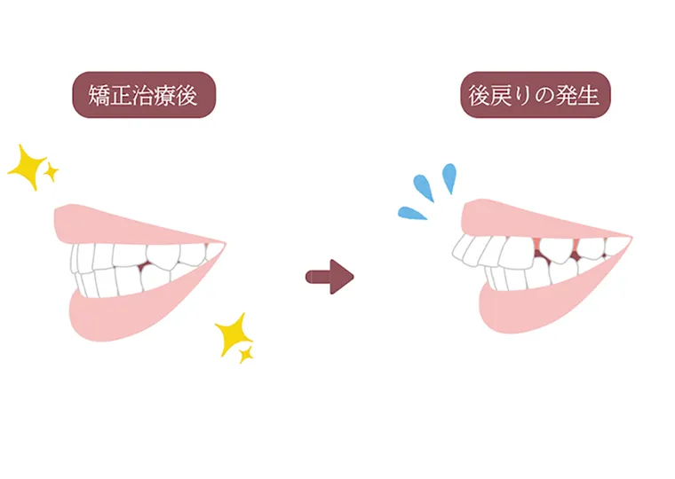 後戻りの再矯正