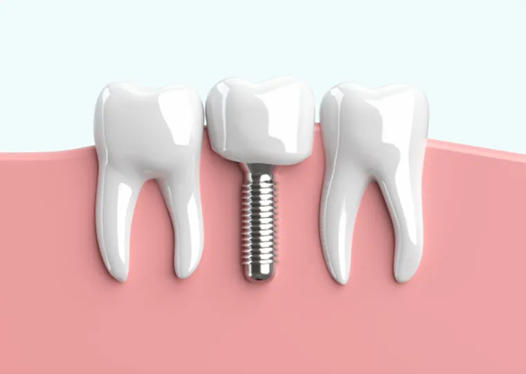 補綴物を安定させる