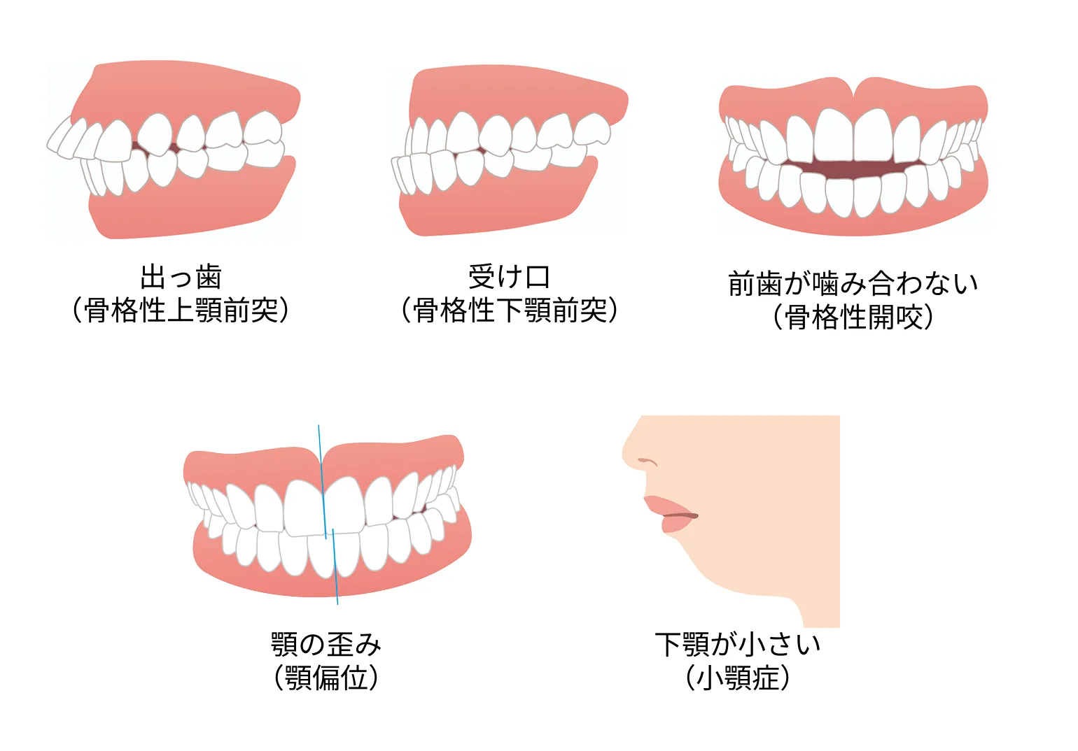 外科矯正の対象になる症例