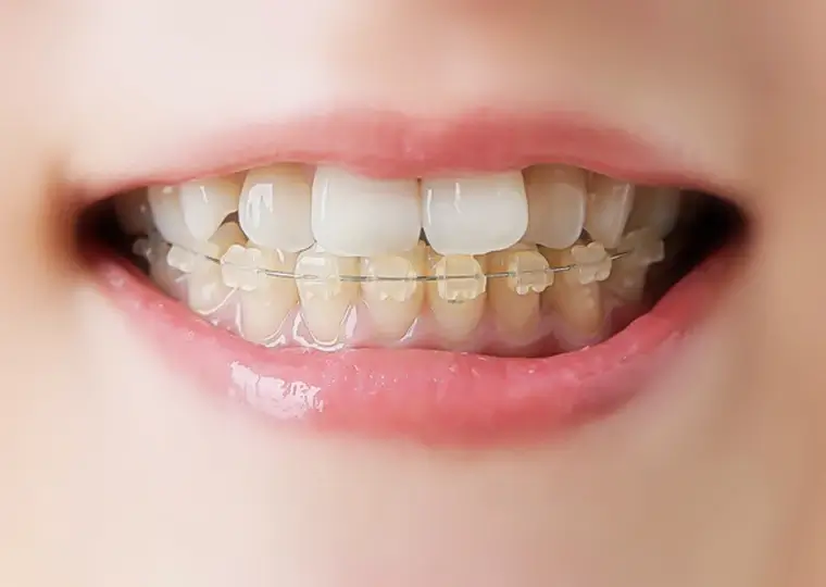 ハーフリンガル