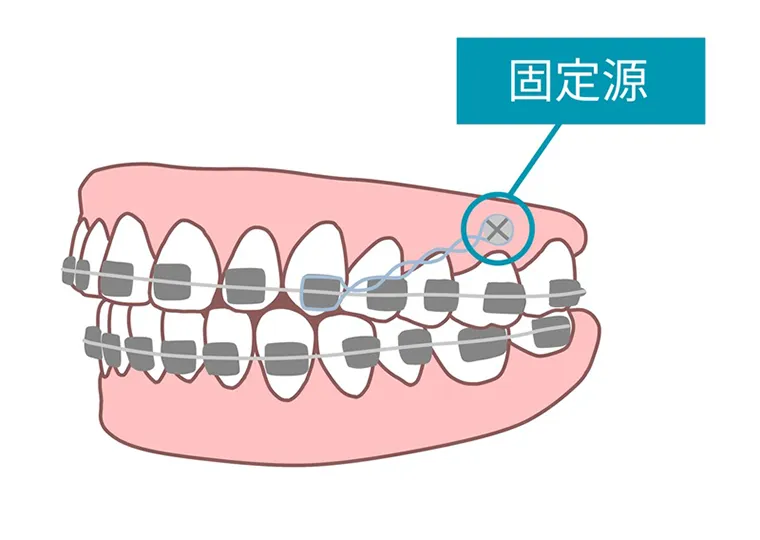 アンカースクリューのメリットと使用目的