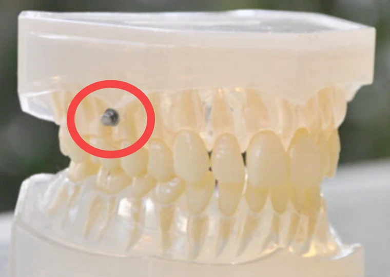 アンカースクリューの埋入