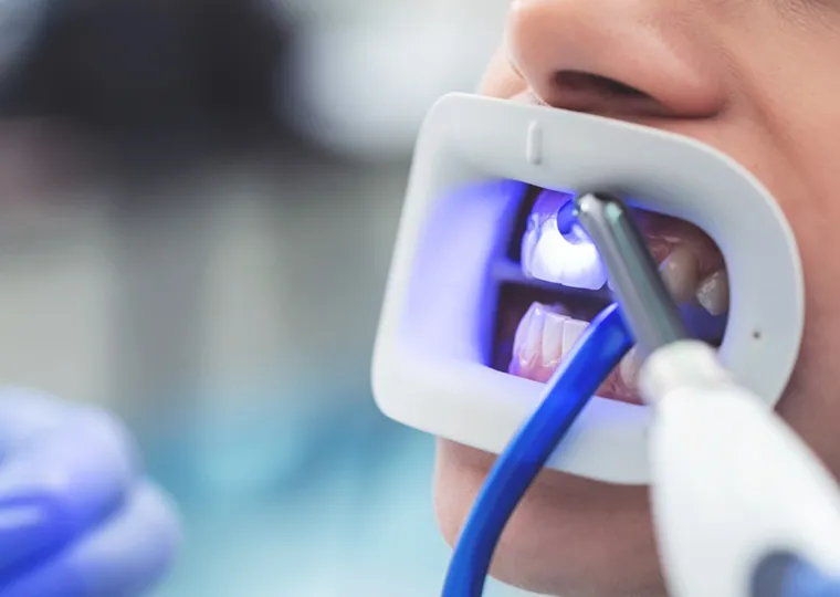 オフィスホワイトニング