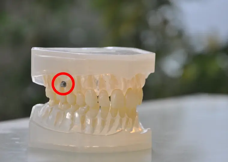 アンカースクリューを併用