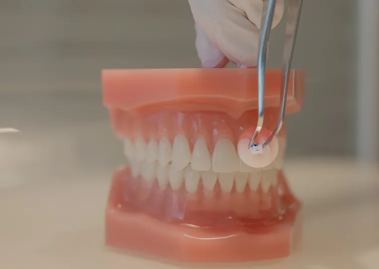 セルフライゲーションを採用